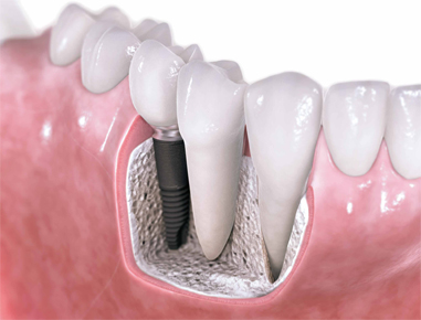 Implant are small cylindrical titanium fixtures that replace missing tooth...