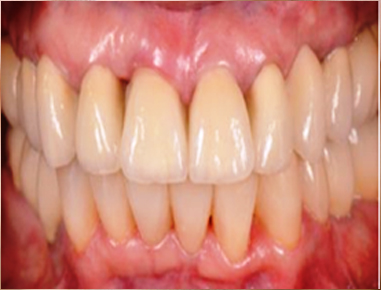 Crown / bridge restore the appearance and function of weak...